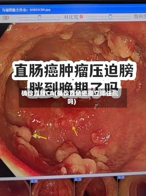 确诊直肠CA(确诊直肠癌是立即住院吗)