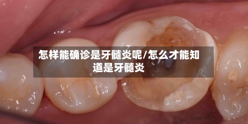 怎样能确诊是牙髓炎呢/怎么才能知道是牙髓炎-第3张图片