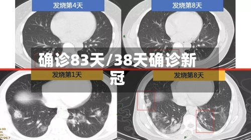 确诊83天/38天确诊新冠-第2张图片