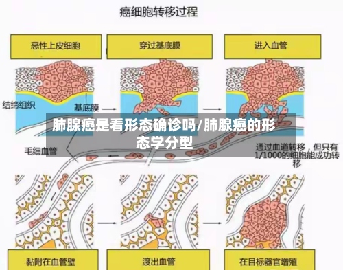 肺腺癌是看形态确诊吗/肺腺癌的形态学分型-第2张图片