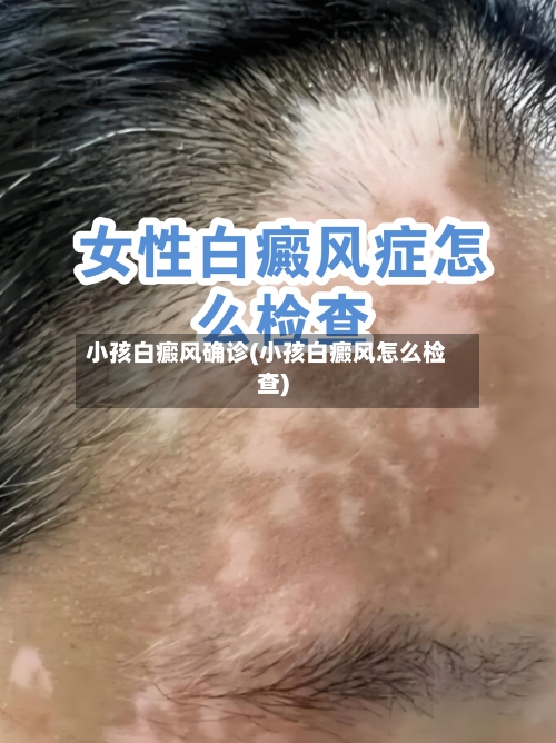 小孩白癜风确诊(小孩白癜风怎么检查)-第3张图片