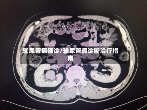 输尿管癌确诊/输尿管癌诊断治疗指南-第2张图片