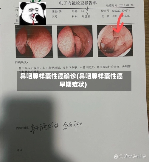 鼻咽腺样囊性癌确诊(鼻咽腺样囊性癌早期症状)-第2张图片