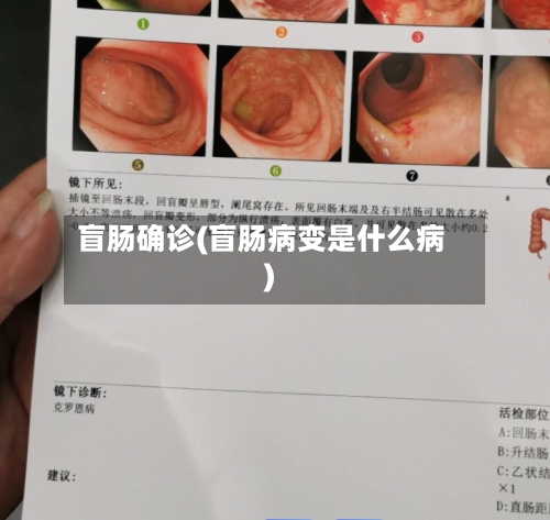 盲肠确诊(盲肠病变是什么病)