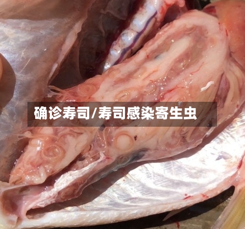 确诊寿司/寿司感染寄生虫-第3张图片