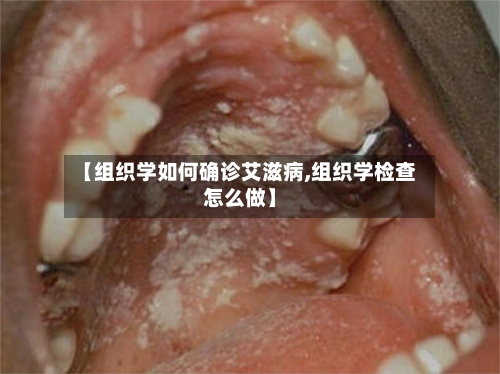 【组织学如何确诊艾滋病,组织学检查怎么做】-第2张图片