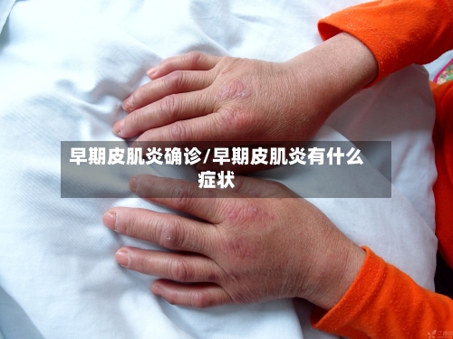 早期皮肌炎确诊/早期皮肌炎有什么症状
