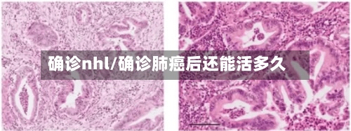 确诊nhl/确诊肺癌后还能活多久