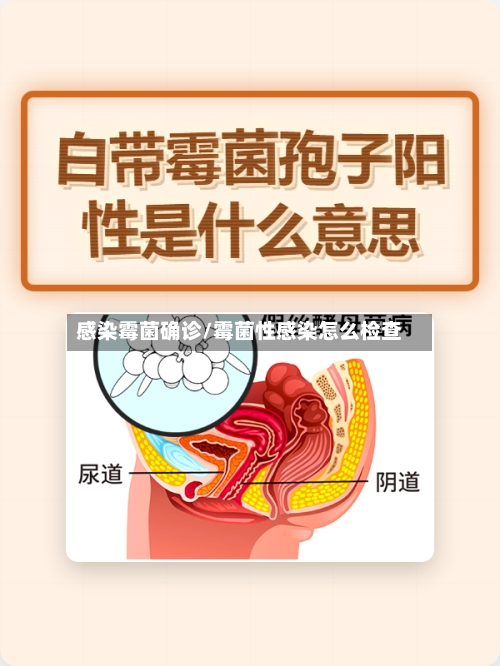 感染霉菌确诊/霉菌性感染怎么检查-第3张图片