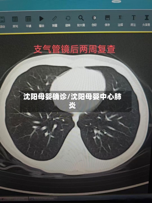 沈阳母婴确诊/沈阳母婴中心肺炎-第2张图片