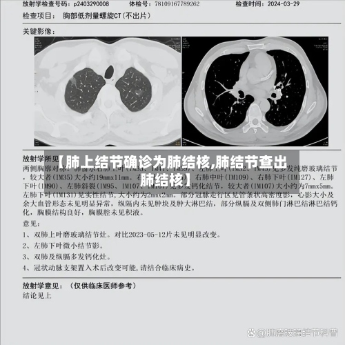 【肺上结节确诊为肺结核,肺结节查出肺结核】