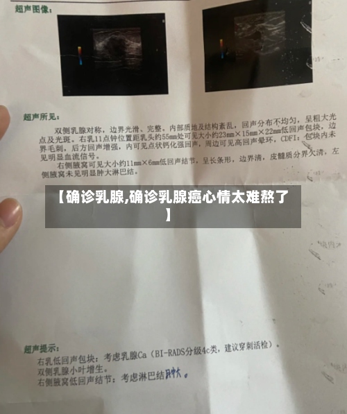 【确诊乳腺,确诊乳腺癌心情太难熬了】-第3张图片