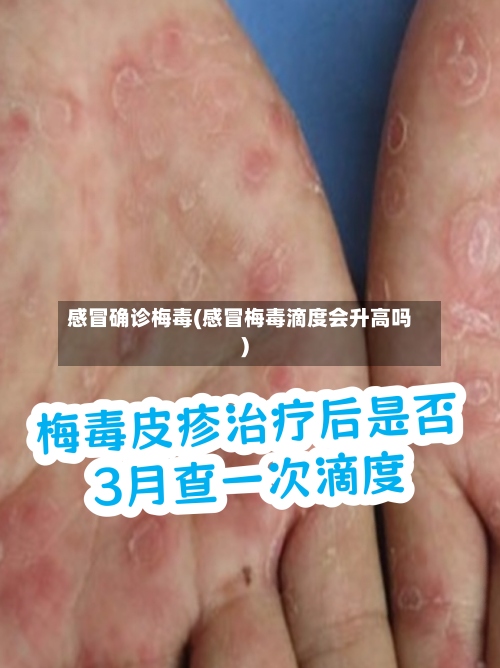 感冒确诊梅毒(感冒梅毒滴度会升高吗)