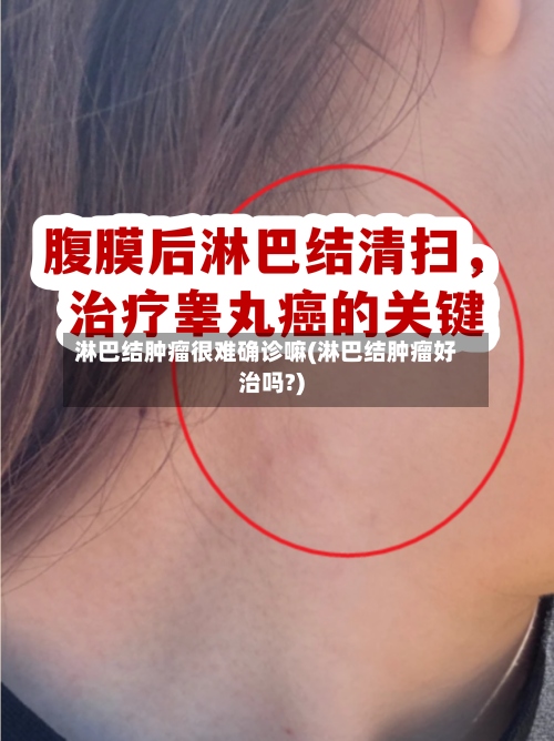 淋巴结肿瘤很难确诊嘛(淋巴结肿瘤好治吗?)