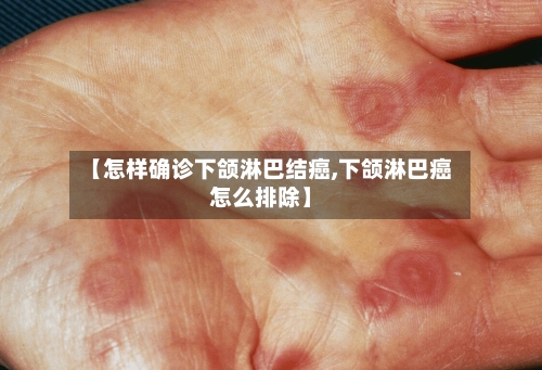 【怎样确诊下颌淋巴结癌,下颌淋巴癌怎么排除】