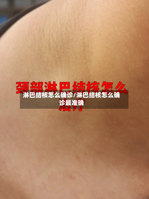 淋巴结核怎么确诊/淋巴结核怎么确诊最准确-第3张图片