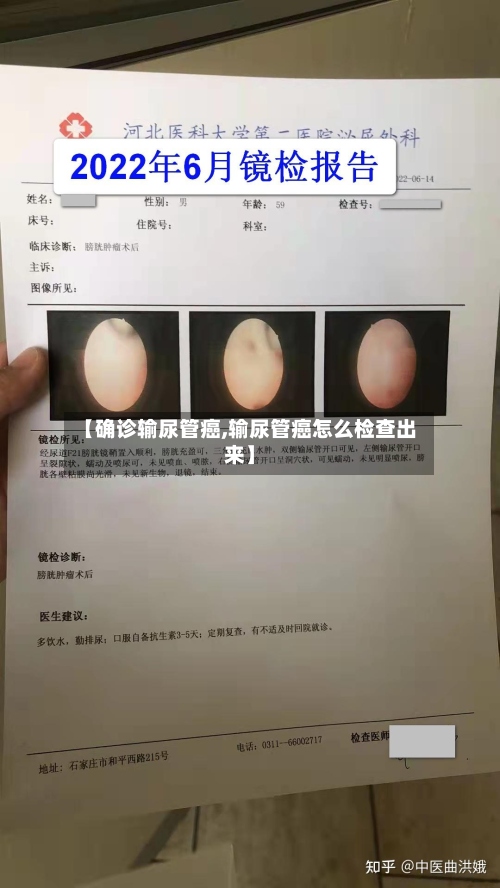 【确诊输尿管癌,输尿管癌怎么检查出来】-第2张图片