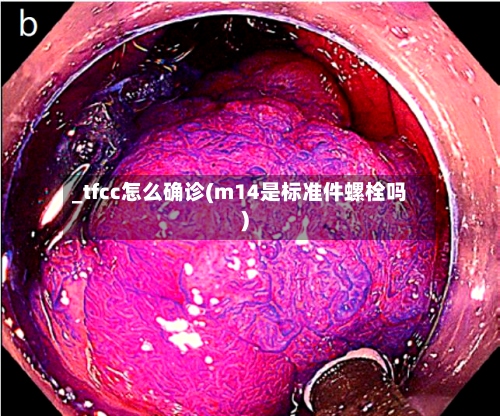_tfcc怎么确诊(m14是标准件螺栓吗)-第2张图片