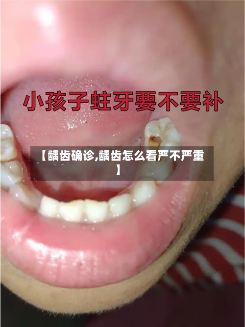 【龋齿确诊,龋齿怎么看严不严重】-第2张图片
