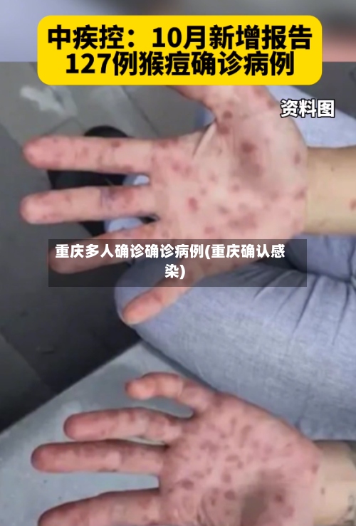 重庆多人确诊确诊病例(重庆确认感染)-第2张图片