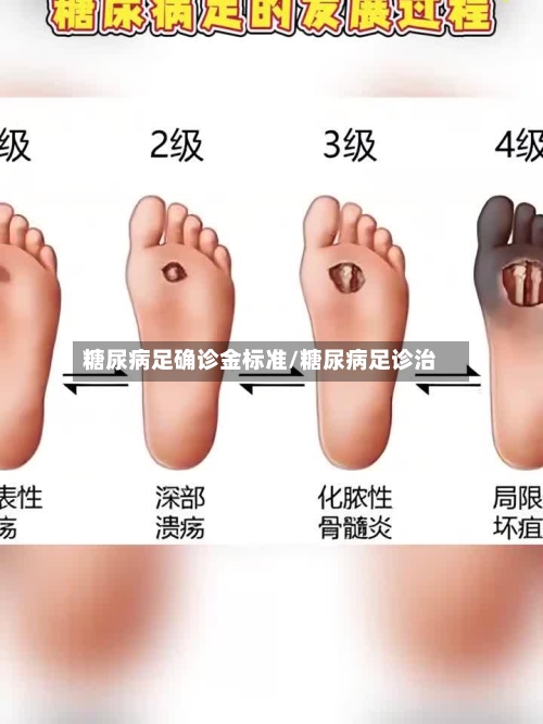 糖尿病足确诊金标准/糖尿病足诊治-第2张图片
