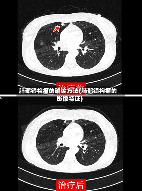 肺部错构瘤的确诊方法(肺部错构瘤的影像特征)-第2张图片