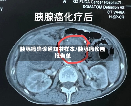 胰腺癌确诊通知书样本/胰腺癌诊断报告单
