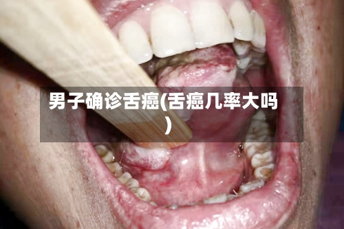 男子确诊舌癌(舌癌几率大吗)