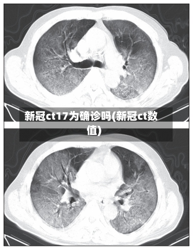 新冠ct17为确诊吗(新冠ct数值)