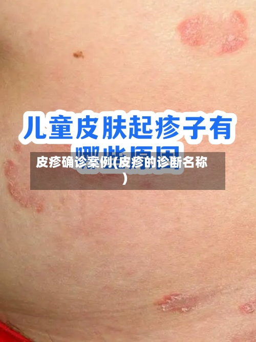皮疹确诊案例(皮疹的诊断名称)-第2张图片