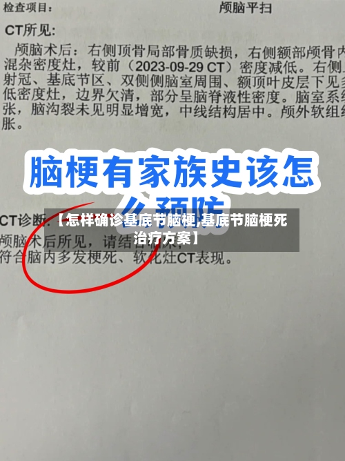 【怎样确诊基底节脑梗,基底节脑梗死治疗方案】-第2张图片