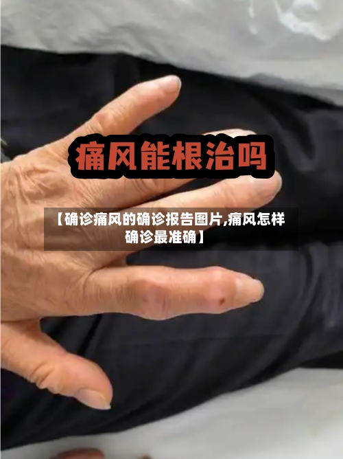 【确诊痛风的确诊报告图片,痛风怎样确诊最准确】