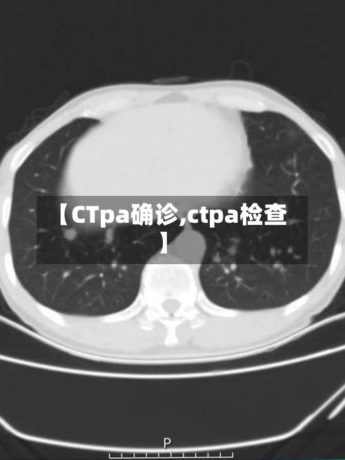 【CTpa确诊,ctpa检查】-第2张图片