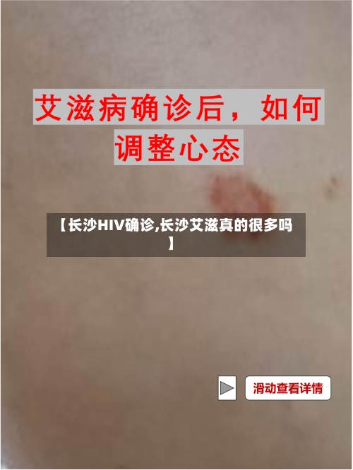 【长沙HIV确诊,长沙艾滋真的很多吗】-第2张图片
