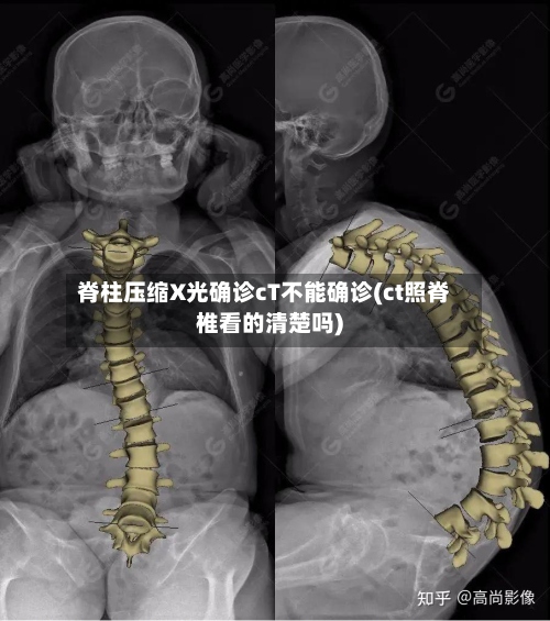脊柱压缩X光确诊cT不能确诊(ct照脊椎看的清楚吗)-第3张图片