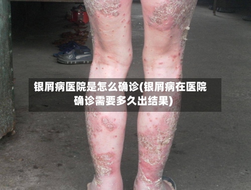 银屑病医院是怎么确诊(银屑病在医院确诊需要多久出结果)