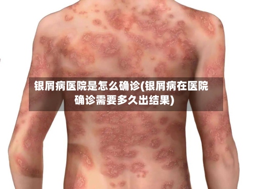 银屑病医院是怎么确诊(银屑病在医院确诊需要多久出结果)-第2张图片