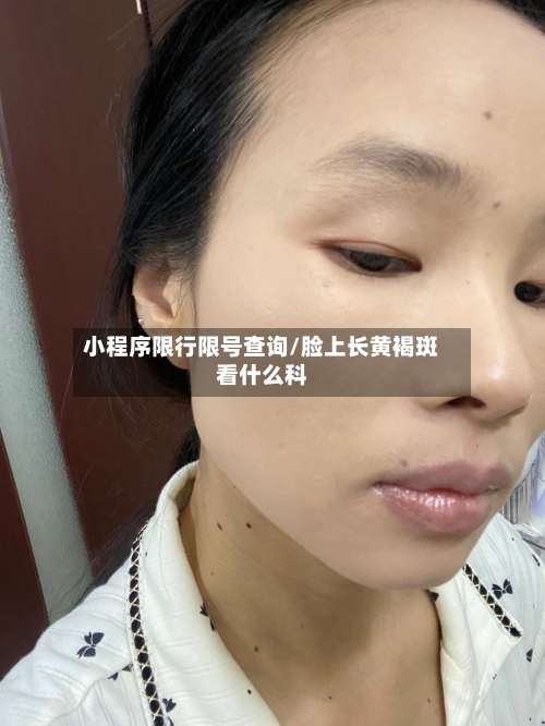 小程序限行限号查询/脸上长黄褐斑看什么科-第2张图片
