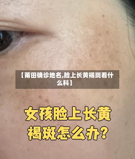 【莆田确诊地名,脸上长黄褐斑看什么科】